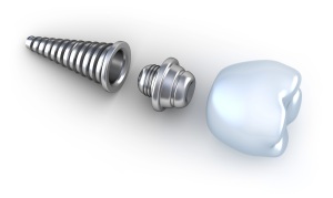 implantes-dentales-rpf-I